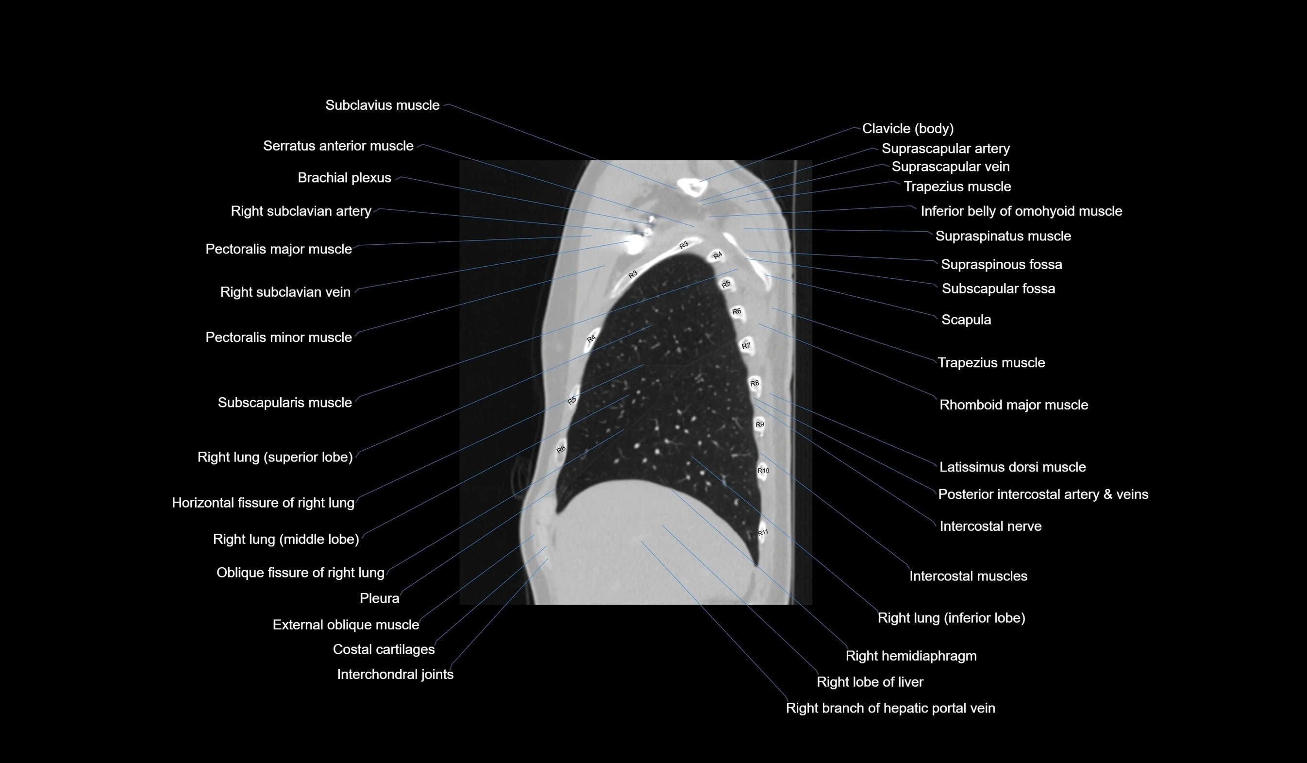 CT chest (thorax) lung window labelled sagittal cross sectional anatomy radiology image-00032.webp